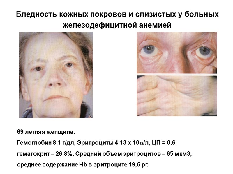 Бледность кожных покровов и слизистых у больных железодефицитной анемией 69 летняя женщина.  Гемоглобин